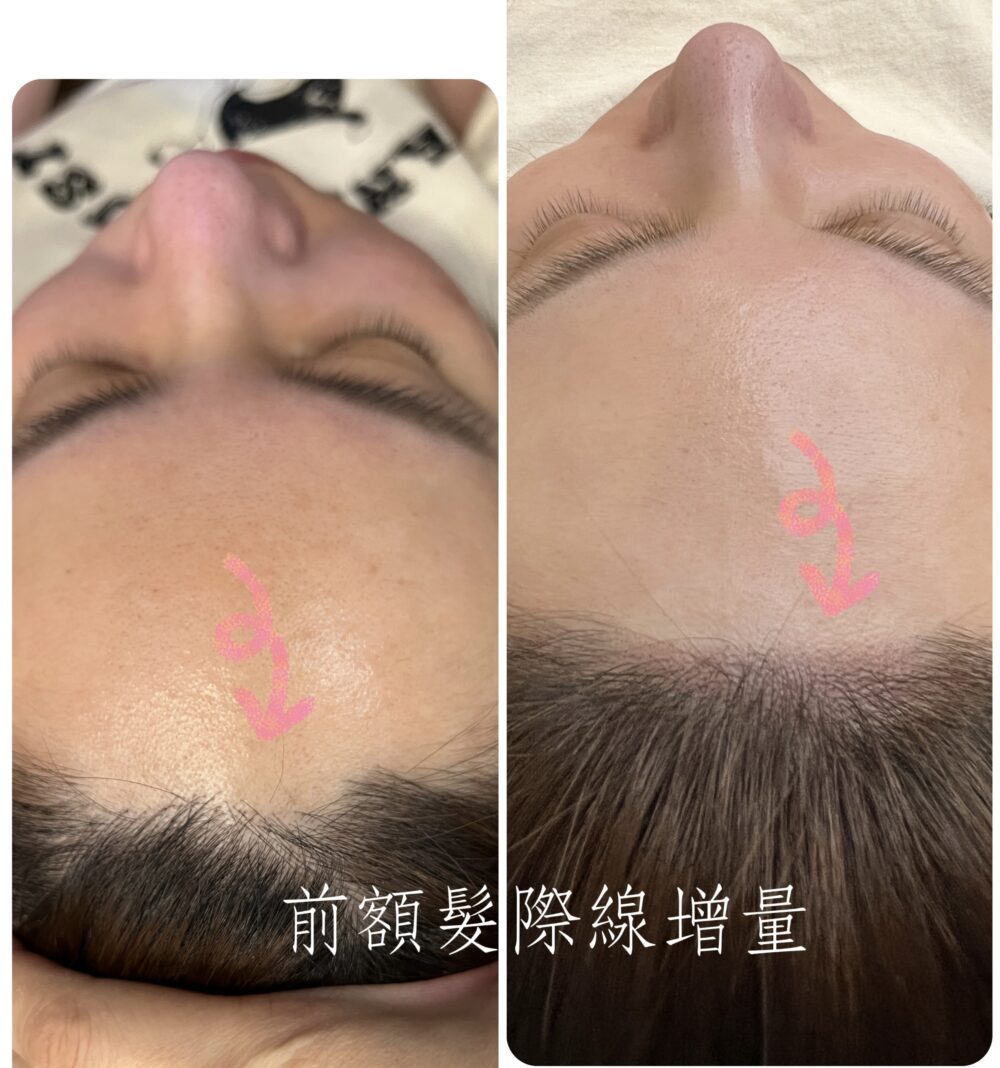 頭皮髮際線紋繡（以評估面積後另行報價，直接LINE@）
